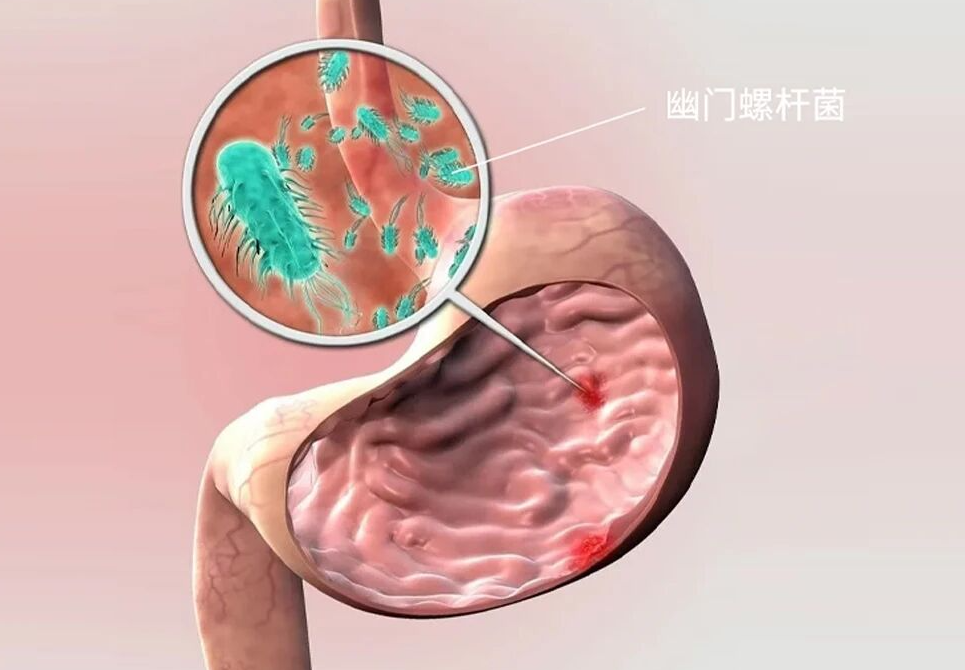 从胃部慢性疾病到胃癌，早踩刹车早安心！