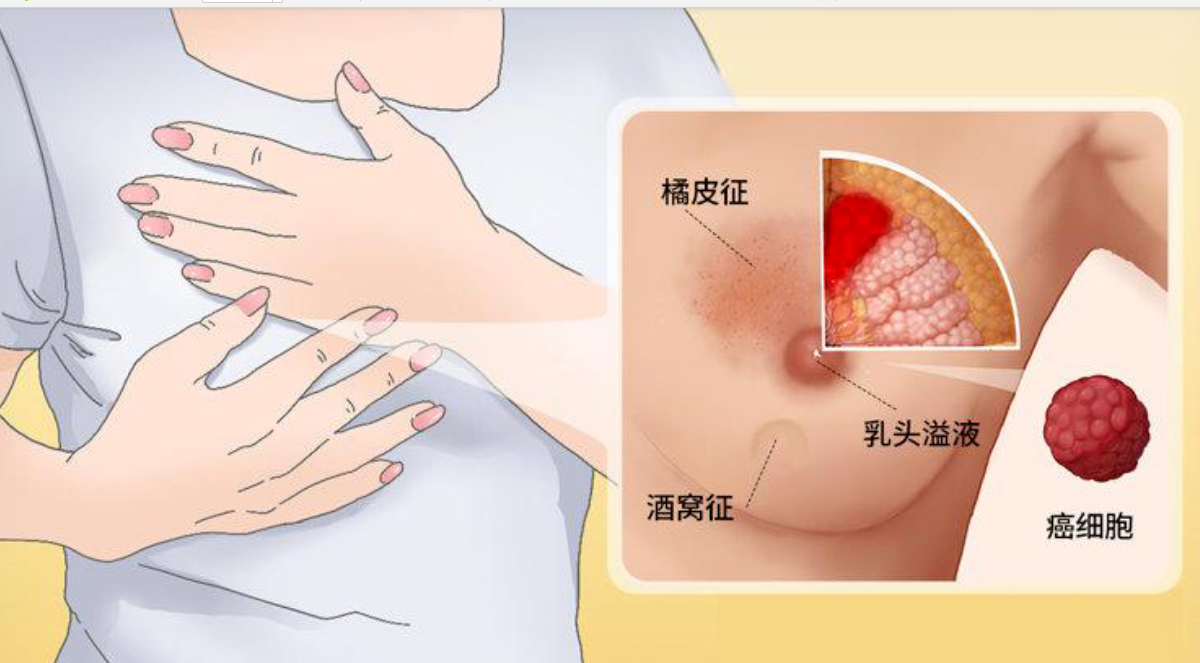 乳腺健康，不止于一次检查｜一生的守护，从全周期管理开始